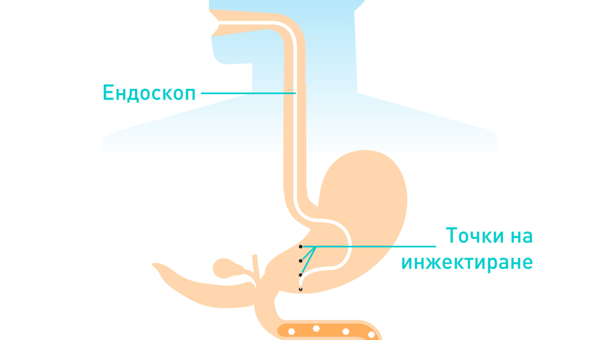 Стомашен ботокс - ВИТА
